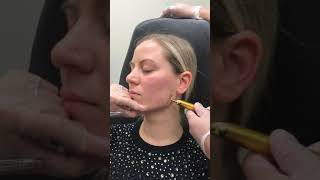 Jawline Filler Injection Technique by Dr Tina Ho [upl. by Libnah]