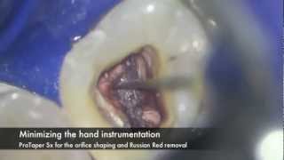 Preendodontic build up  NSRCT [upl. by Metsky]