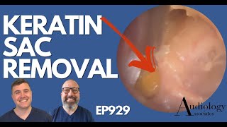 SKIN SAC REMOVED FROM EAR  EP929 [upl. by Ivette269]