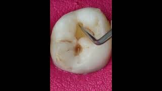 How to find cavity in teethTeeth recontractiontooth Carries cavitiesteeth talk girldentistry [upl. by Lali]