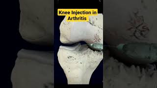 How Knee Injection is Helpful In Arthritis ✓ arthritis kneearthritis kneepain osteoarthritis [upl. by Vincelette]