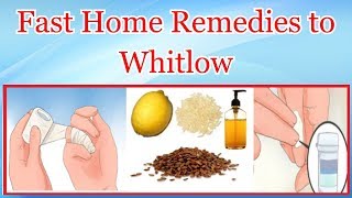 Fast Home Remedies to Whitlow [upl. by Yesnik]