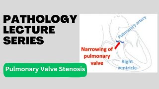 Pulmonary Valve Stenosis  Pathology Lecture Series  Lecture 17 [upl. by Roee]