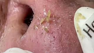 Nose Blackheads Removal with Haris Beauty  2022 [upl. by Ablem236]