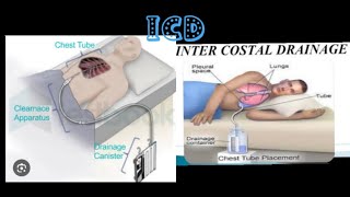 intercostal drainagerecurrent plueral effusionmbbsprocedure medicose Sudarshanlipane17 ⛑️⛑️🩺 [upl. by Norrv]