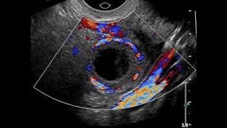 How to differentiate between corpus luteum amp heterotopic pregnancy [upl. by Appleby695]