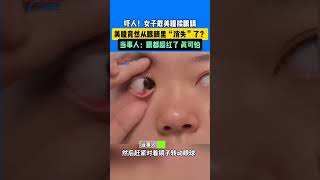 嚇人女子戴美瞳揉眼睛，美瞳竟從眼睛裏“消失”了 當事人 眼都磨紅了真後怕 真實事件 奇聞趣事 新聞 shorts [upl. by Niatirb696]