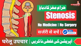 Spinal Stenosis  Reasons amp Best Treatment  Home Exercises  UrduHindi [upl. by Atterbury161]