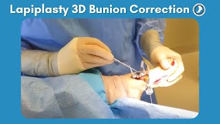 Lapiplasty Procedure  3D Bunion Correction with Dr Paul Steinke [upl. by Maurer47]