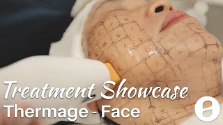 Thermage Face Skin Tightening  Treatment Showcase [upl. by Brotherson]