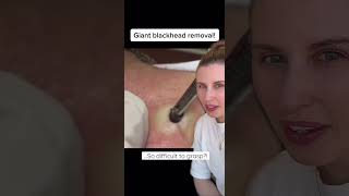 Giant Blackhead Removal Leaves Huge Hole [upl. by Plante655]