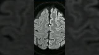 Understanding CreutzfeldtJakob Disease shorts youtubeshorts science radiology [upl. by Nimrac523]