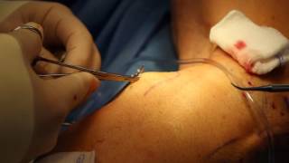 Microstab Phlebectomy  Varicose Vein Removal [upl. by Fong]