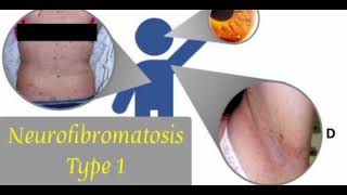 Neurofibromatosis mrcpch Clinical General Examination [upl. by Pinzler]