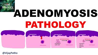 ADENOMYOSIS  Pathology Clinical Features Diagnosis amp treatment [upl. by Arbrab]