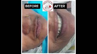 DENTAL IMPLANT SUPPORTED COMPLETE OVERDENTURE RESTORED FASCIAL AND DENTAL AESTHETIC amp FUNCTION [upl. by Jeanelle968]