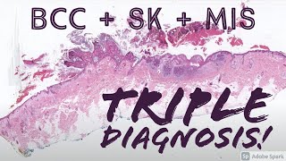 Triple Diagnosis Melanoma in situ  Basal cell carcinoma  Seborrheic Keratosis dermpath basics [upl. by Cormick]