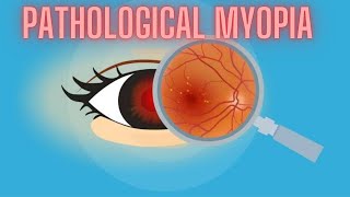 Pathological Myopia  High Myopia  Ophthalmology Lecture [upl. by Naenaj]