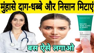 bye bye acne scars amp mark cream review in hindi  how to use bye bye acne scars amp mark cream [upl. by Aver]