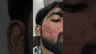 Acne Pimples Treatment By Dr Ahsan Ahmad Skin Care Clinic Call 91 7417928805 [upl. by Roose]