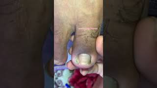 Deep ingrown toenail trimming 🥶🥶🥶🥶 [upl. by Haela735]