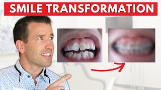 Unbelievable Braces Transformation [upl. by Woolcott]