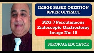 PERCUTANEOUS ENDOSCOPIC GASTROSTOMY UPPER GI TRACT Image Based Question [upl. by Annis902]