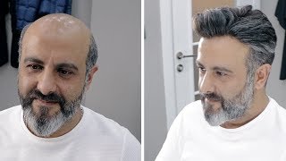 PROTEZ SAÇ UYGULAMASI  Hair Replacement [upl. by Ertnom]