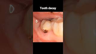 Filling tooth decay process dentistry dentist filling tooth [upl. by Akived644]