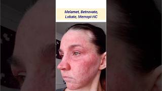 Melamet Betnovate Lobate MemopiHC Skinlite Skin Shine Lomela स्टीरोइड cream के उदाहरण हैं [upl. by Marcelle]