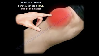 What Is BURSITIS  Everything You Need To Know  Dr Nabil Ebraheim [upl. by Matazzoni339]