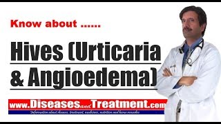 Hives Urticaria amp Angioedema  Causes Diagnosis Symptoms Treatment [upl. by Polish940]