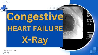 Congestive Heart Failure Chest X Ray CHF Radiology [upl. by Slifka221]