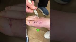 Amazing Suture Removal 🤯 shorts [upl. by Caughey]