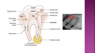 Diseases of pulp and periapical area [upl. by Gnik]