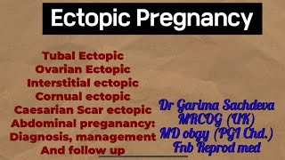 Ectopic pregnancy diagnosis management and follow up plan [upl. by Bellaude]