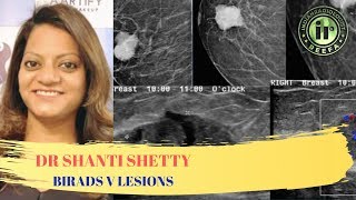 TMT BIRADS V Lesions by Dr Shanti Shetty [upl. by Meave559]