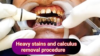 Heavy stains and calculus removal  Deep teeth cleaning treatment  drhirenpatelvlo [upl. by Aydan]