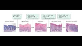 Progression of Squamous cell Carcinoma [upl. by Suinotna]