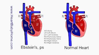 56 Ebsteins Anomaly with pulmonary stenosis [upl. by Danika]