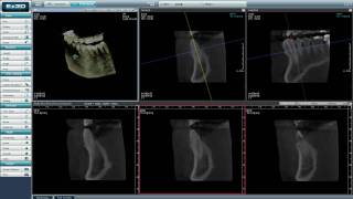 Axial Coronal and Sagittal view on VATECH Cone beam CT Picasso Trio [upl. by Reube]