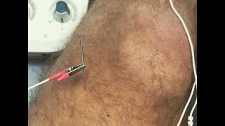 Acupuncture for Relief of Knee Pain [upl. by Etnovahs321]