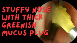 Stuffy Nose With Thick GREENISH Mucus Plug [upl. by Aihsital926]