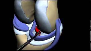 Мениск разрыв и операция [upl. by Thaddus]