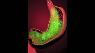 Digestive system gastroesophageal reflux GER or acid reflux 3D Animation [upl. by Yzmar466]