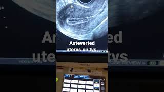 what is Anteverted uterus and how its looks on tvs ultrasound [upl. by Ainnek]