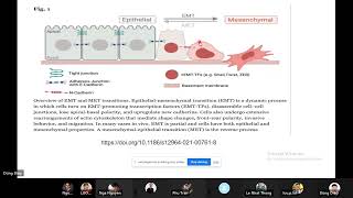 JCS 14 Metaplastic Carcinoma of breast [upl. by Pudens792]