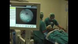 Intubation with Bonfils fiberscope under general anesthesia [upl. by Sorilda]