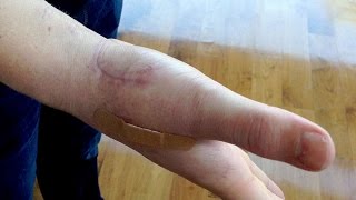 BREAKING MY THUMB LIGAMENT CHALLENGE AFTERMATHGRAPHIC PRANK DISGUSTING GROSS AF [upl. by Akiraa]