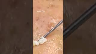 Pickel Ausdrücken Blackheads Akne amp Mitesser entfernen 🔴 23 [upl. by Begga4]